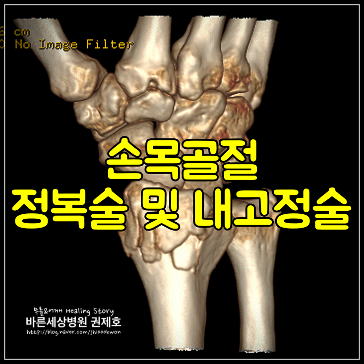 손목골절 정복술 및 내고정술 : 어느 요리사의 소중한 손목