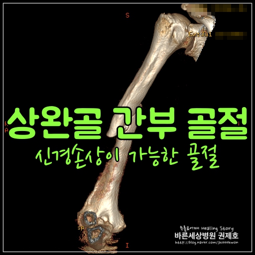 상완골 간부 골절 (위팔뼈골절) : 신경 손상 없이 금속판 고정