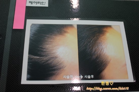  안양 반영구화장 전문 병원에서