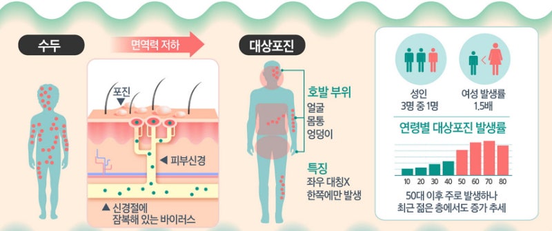 대상포진일기 2 : 오른손 대상포진 진단 1주일 후 신경통 증상이 나타나 호전을 위해 노력하는 제2병원