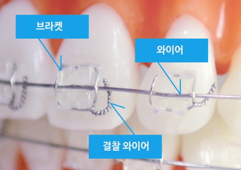 치아교정 월치료 : 교정 와이어 교체 O-Ring과 파워체인 : 네이버 블로그
