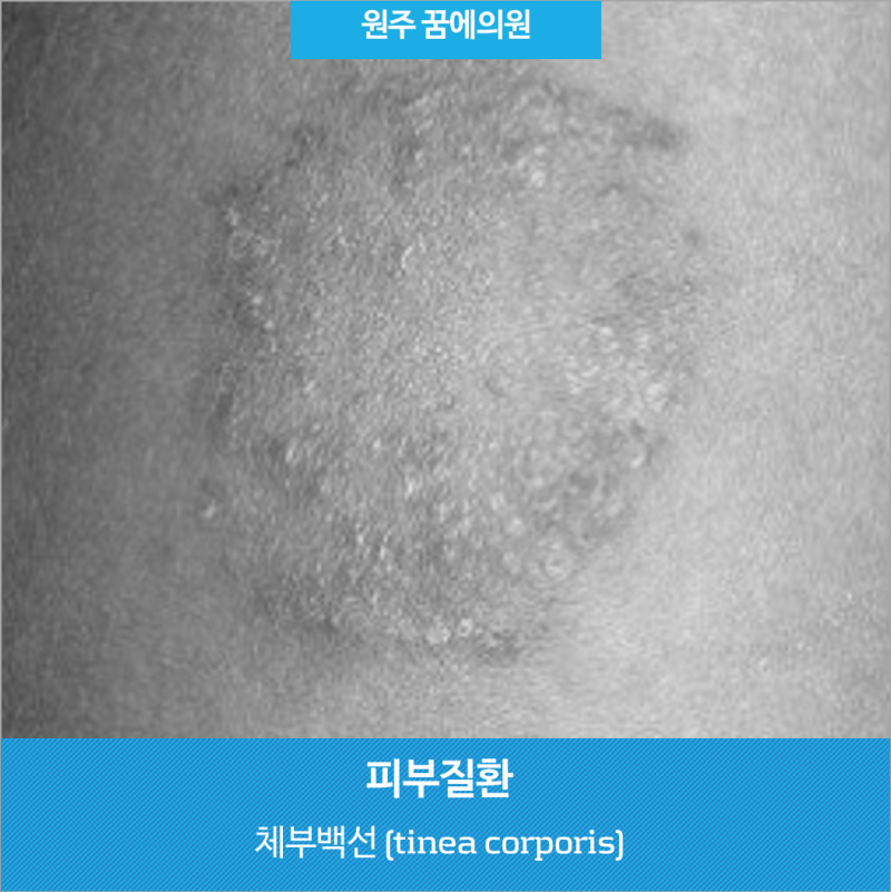원주 - 체부백선 (tinea corporis) : 네이버 블로그