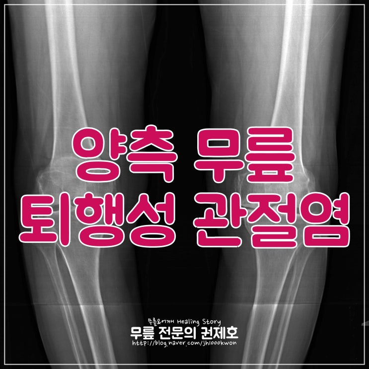 양측 무릎 퇴행성 관절염의 치료 로직