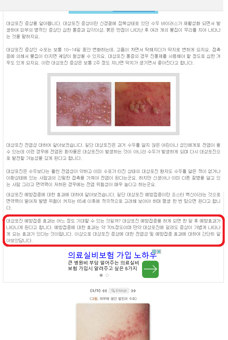 대상포진 초기증상 예방접종 전염성