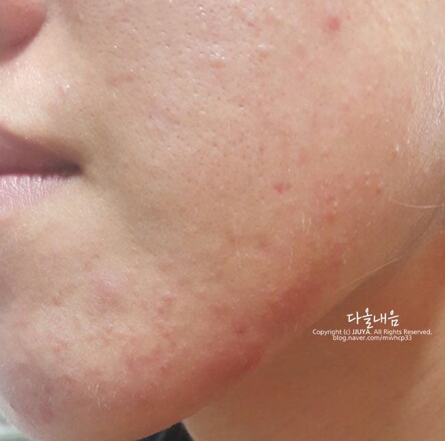 클라리소닉 여드름 흉터 전후