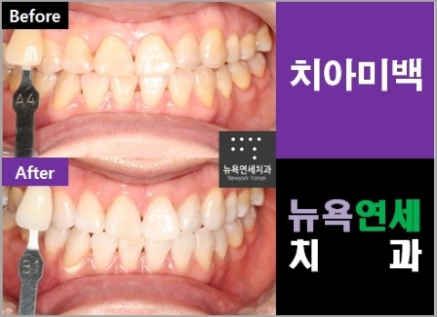전문가치아미백,치아미백전문,치아미백하는방법,치아미백시술