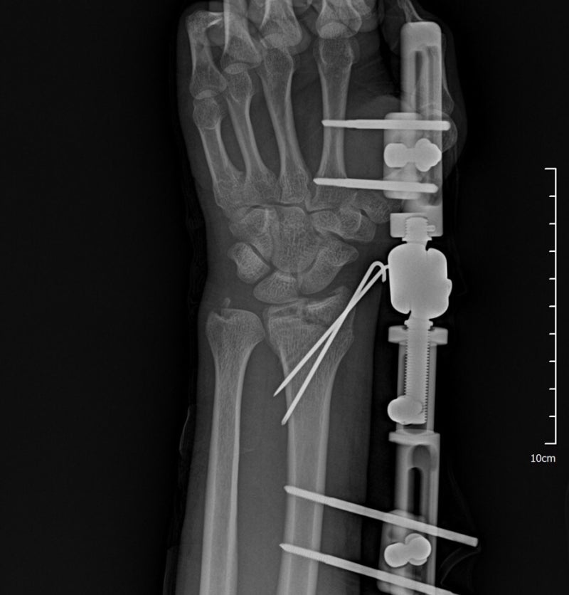 요골(손목) 원위부 골절 ( Fracture of distal radius)의 장해진단과 보상 : 네이버 블로그