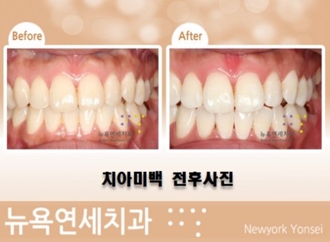  치아미백유명한곳,치아미백,치아미백추천,치아미백방법