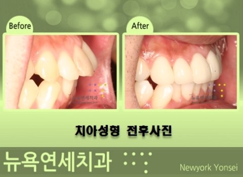  @@@@앞니교정전문,앞니교정,앞니성형교정,앞니교정방법##@@