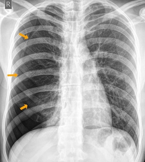 [KMLE] 자발성 기흉, Spontaneous pneumothorax : 네이버 블로그