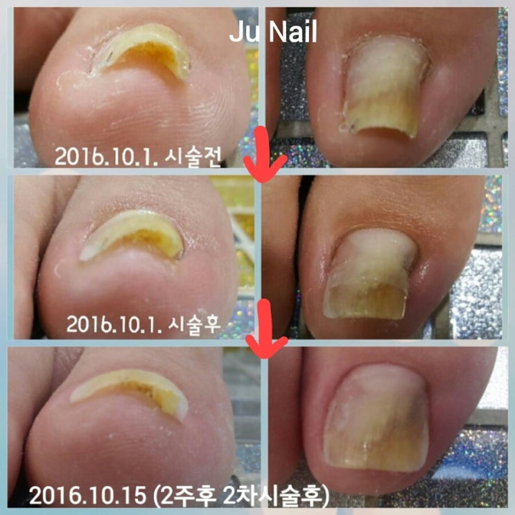 분당용인보정수지죽전네일/주네일/파고드는발톱교정.내향성발톱교정 분당용인보정수지죽전네일/주네일/파고드는발톱교정.내향성발톱교정