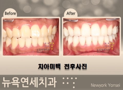  치아미백 후 효과는 어느 정도 개선이 되나요?