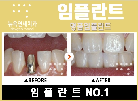  @@@@인플란트가격,인플란트,인플란트가격비교,인플란트치과@@##