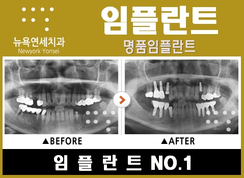  @@@@임플란트어금니수술,임플란트어금니,임플란트어금니방법,임플란트어금니가격@@@@
