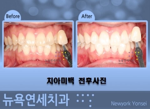  미백치아사진,미백치아,이미백,치아미백병원