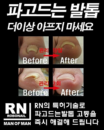   분당용인보정동수지죽전네일/주네일/파고드는발톱교정.내향성발톱교정.내성발톱교정