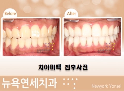  스탠다드치아미백,전문가치아미백,연예인치아미백,연예인미백