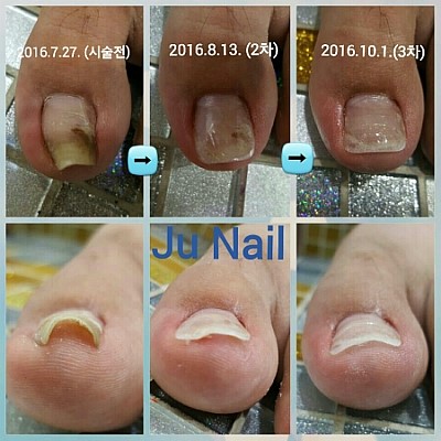 분당용인보정동수지죽전네일/주네일/파고드는발톱교정.내향성발톱교정.내성발톱교정 분당용인보정동수지죽전네일/주네일/파고드는발톱교정.내향성발톱교정.내성발톱교정