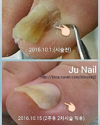 분당용인보정동수지죽전네일/주네일/파고드는발톱교정.내향성발톱교정.내성발톱교정