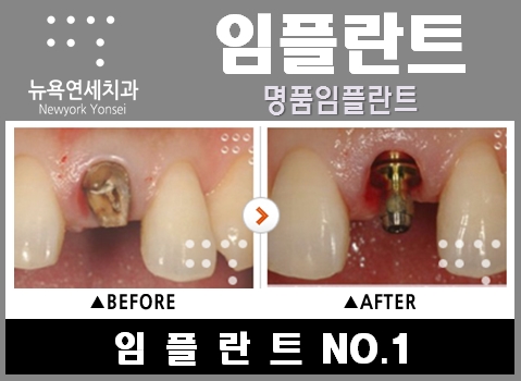  ####임플란트수술과정,임플란트수술,임플란트수술전문,임플란트수술잘하는곳####