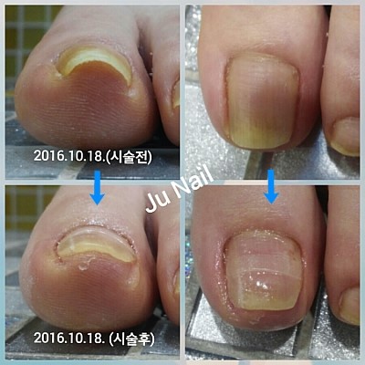   분당용인보정동수지죽전네일/주네일/파고드는발톱관리.내향성발톱관리.내성발톱관리