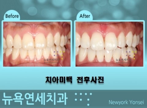 치아미백종류,치아미백가격,치아미백상담,치아미백후기