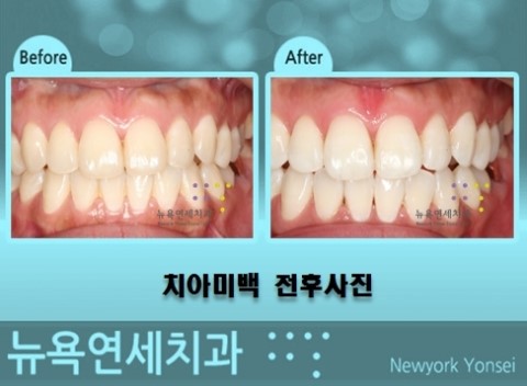  치아미백종류,치아미백가격,치아미백상담,치아미백후기
