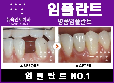  임플란트앞니치료,임플란트앞니,임플란트앞니시술,임플란트앞니수술