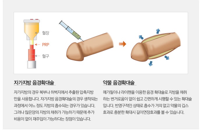 길이연장술 약물 없이 극복할수 있다고 10