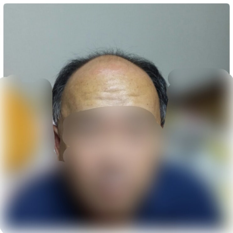  [춘천가발][춘천가발전문점]춘천에서 맞춤가발 제일 잘 하는 미용실~~아빠가 달라졌어요~~