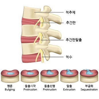 디스크(추간판탈출증)의 장해진단과 보상 : 네이버 블로그