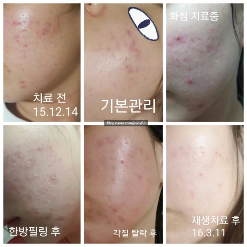 여드름흉터피부과 치료 하고 이제 비비 2