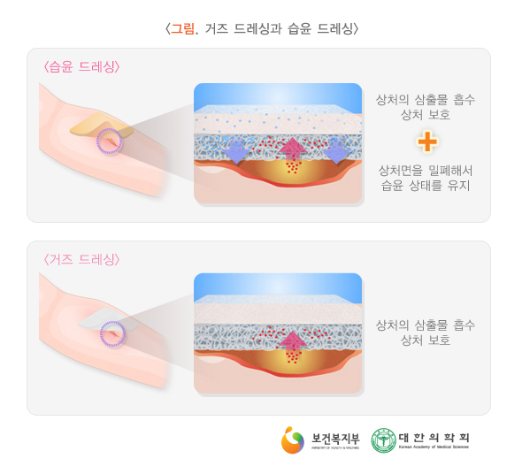 흉터 연결 권장 유아 상처 관리 비교 검토 12