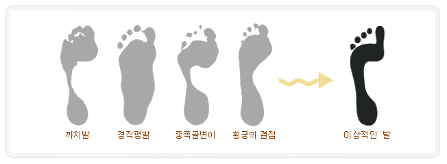  발교정구 알즈너의 종류 4가지[알즈너 인천새샘대리점]
