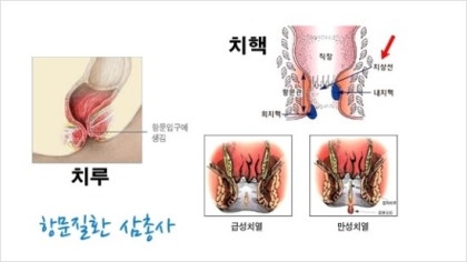 [양평항문외과] 항문 질환 테스트: 나의 항문 질환은?