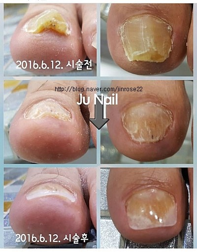 분당용인보정동수지죽전네일/주네일/무좀발톱변형관리전후 분당용인보정동수지죽전네일/주네일/무좀발톱변형관리전후