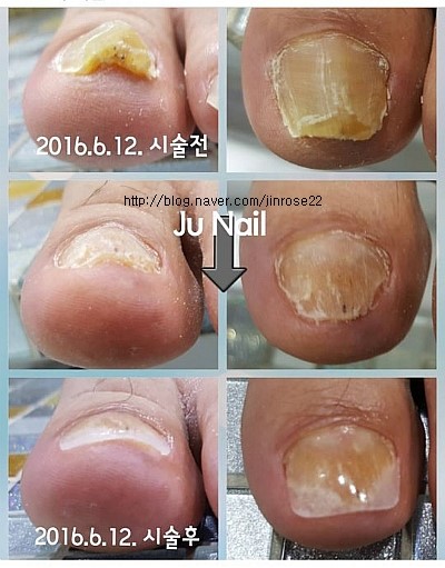 분당용인보정동수지죽전네일/주네일/무좀발톱변형관리전후