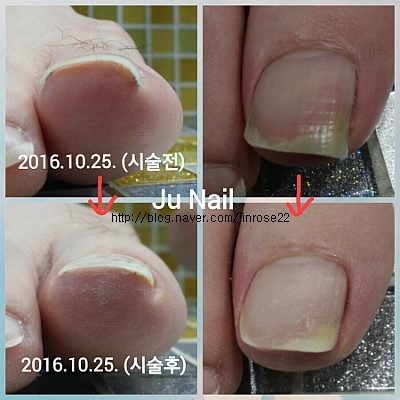 분당용인보정동수지죽전네일/주네일/파고드는발톱