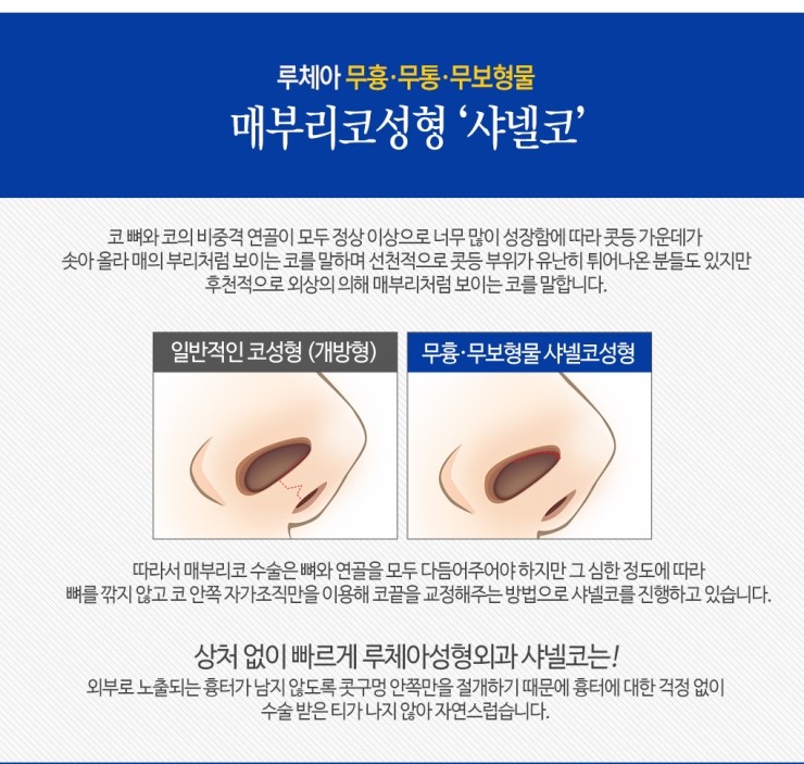 루체아성형외과 매부리코, 수술없이 샤넬코로 자연스럽게~ : 네이버 블로그 루체아성형외과 매부리코, 수술없이 샤넬코로 자연스럽게~ : 네이버 블로그