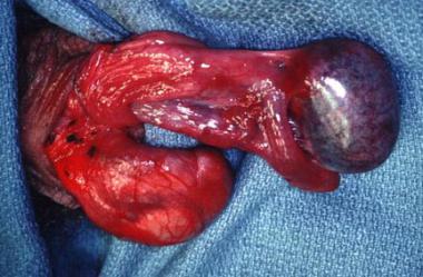 고환통증의 진단 시에 유의사항-4) 고환염전(Testicular Torsion)과의 감별 : 네이버 블로그 고환통증의 진단 시에 유의사항-4) 고환염전(Testicular Torsion)과의 감별 : 네이버 블로그