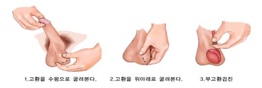 고환통증의 진단 시에 유의사항-4) 고환암(Testicular Cancer)과의 감별 : 네이버 블로그 고환통증의 진단 시에 유의사항-4) 고환암(Testicular Cancer)과의 감별 : 네이버 블로그