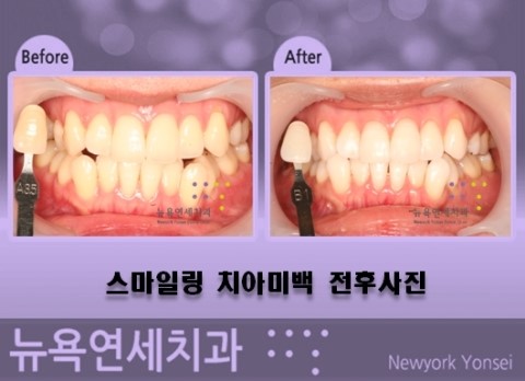 치아미백병원추천,치아미백병원,치아미백병원비용