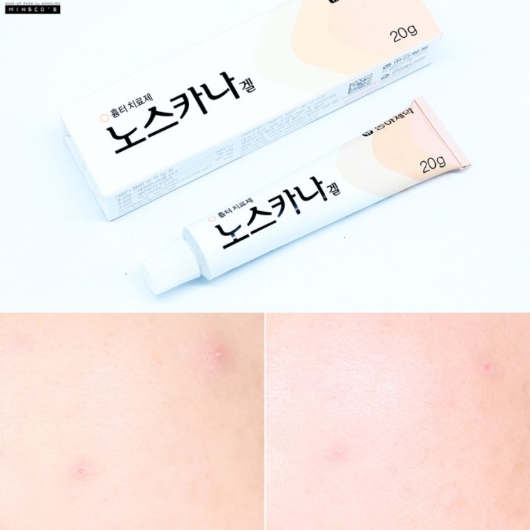 여드름 크림과 여드름 흉터 크림을 따로 사용해야 하는 이유는? 나치 만 있으면됩니다! 9