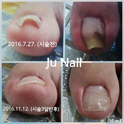 파고드는발톱병원수술후/분당용인보정동수지죽전네일/주네일 파고드는발톱병원수술후/분당용인보정동수지죽전네일/주네일