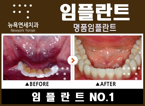  @@@@어금니발치임플란트,어금니임플란트,임플란트병원치료@@@@