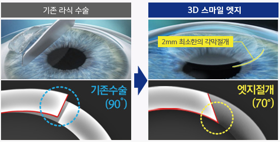 라식수술 후 관리 방법과 3D엣지