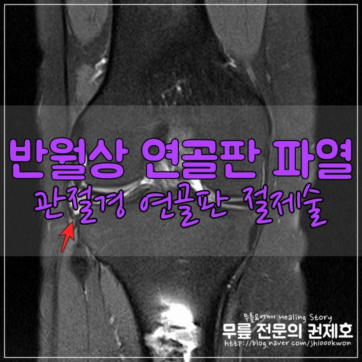  외측 반월상 연골판 파열 : 무릎 관절경을 이용한 연골판 부분 절제술 (아전 절제술)