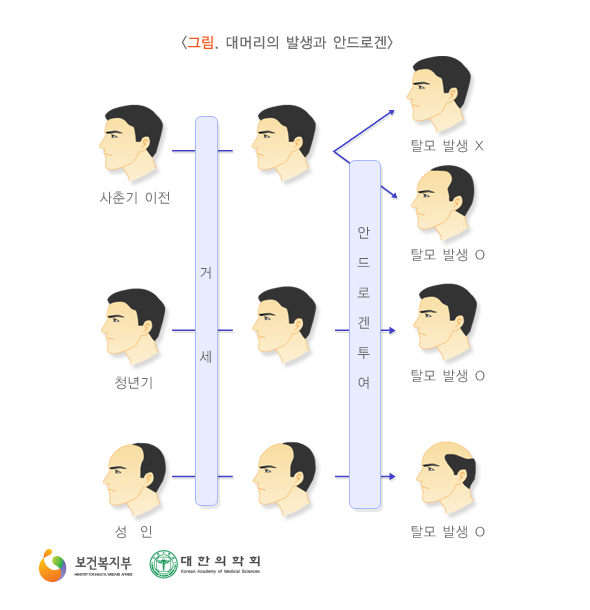 [어차피 남성 탈모] 남성 탈모의 발생 원인과 증상이란!?