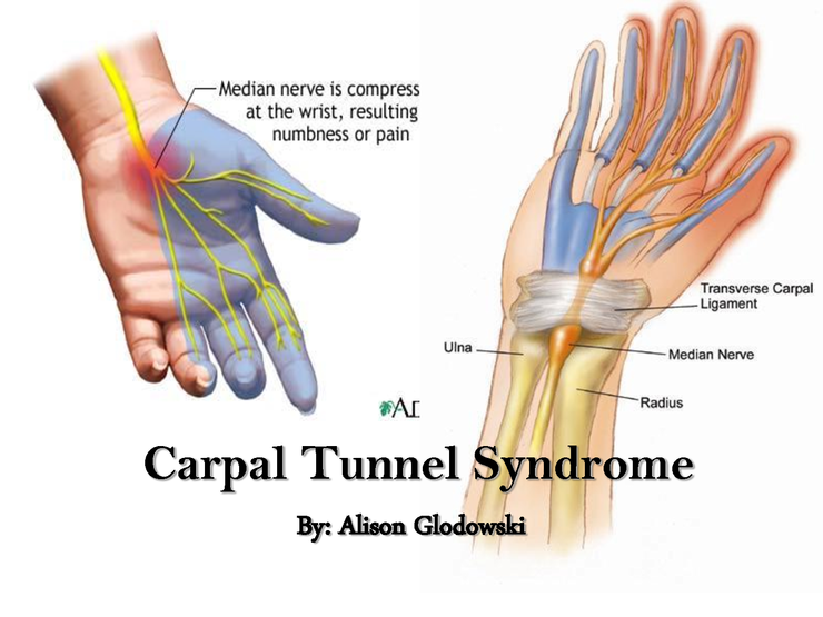 [통증] 부항(cupping)을 수근관증후군(carpal tunnel syndrome) 치료에 적용할 수 있을까?
