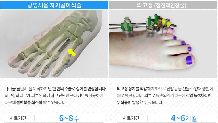 자가골이식술로 치료하는 짧은발가락 단지증 : 네이버 블로그